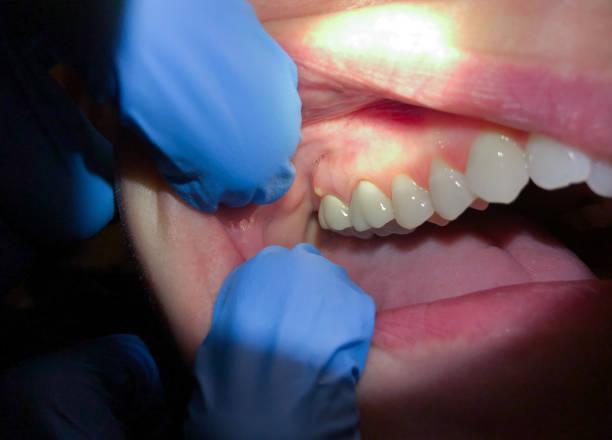 Best Emergency Care for Gum Disease in West Point, NE
